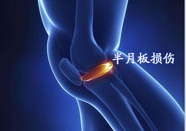 半月板损伤，一定要及时处理！